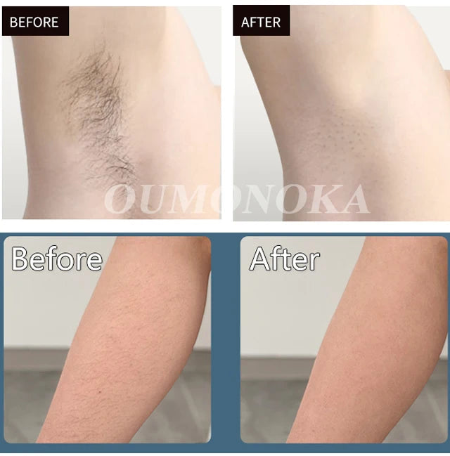 bikini line hair removal