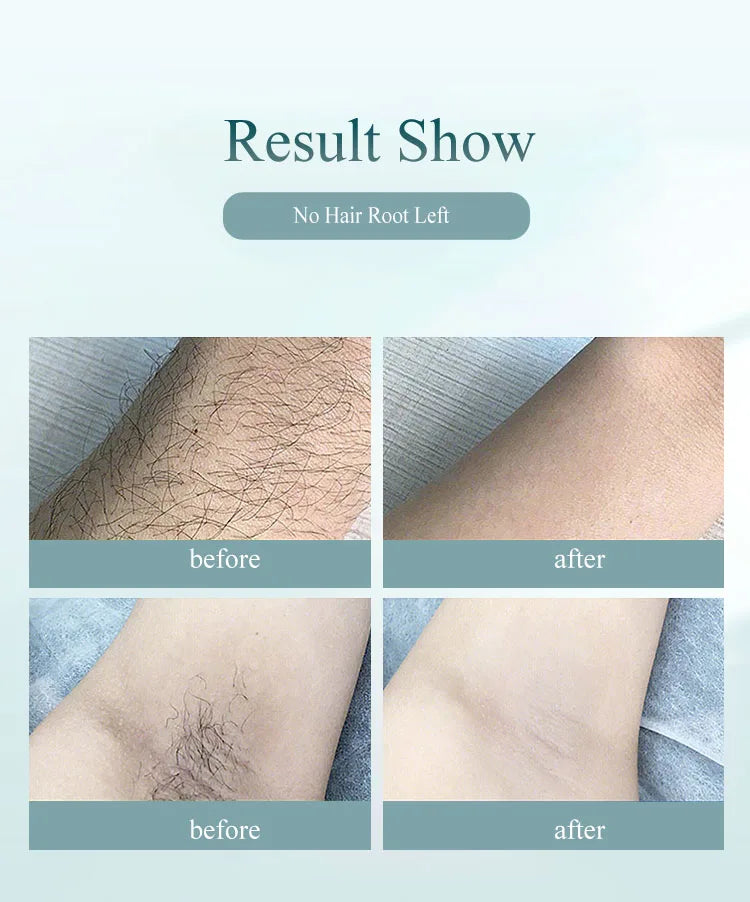 Home laser hair remover