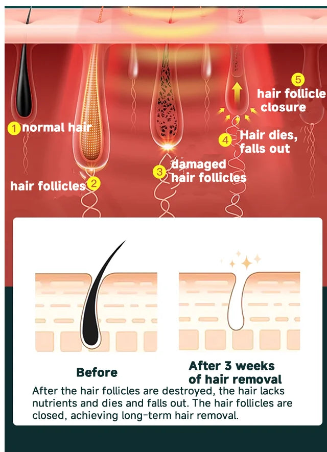 laser hair remover