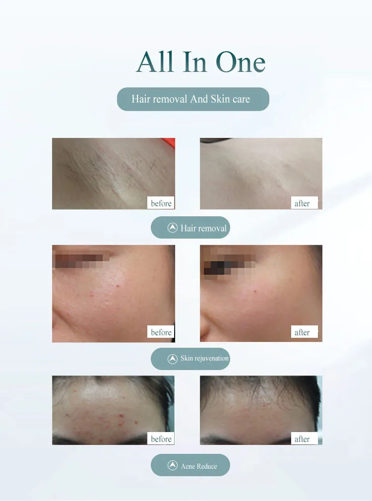 IPL for face and body