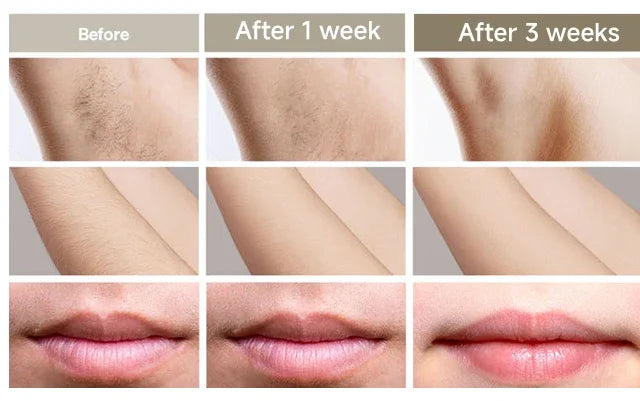 IPL hair removal device